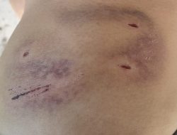 Mahasiswa Juliet Nostra Dasilva Alami Gigitan Anjing 